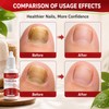 2PCS Fungi Nail ToenailTreatment,Gentle Formula,Effectively lmproves Nails for a More