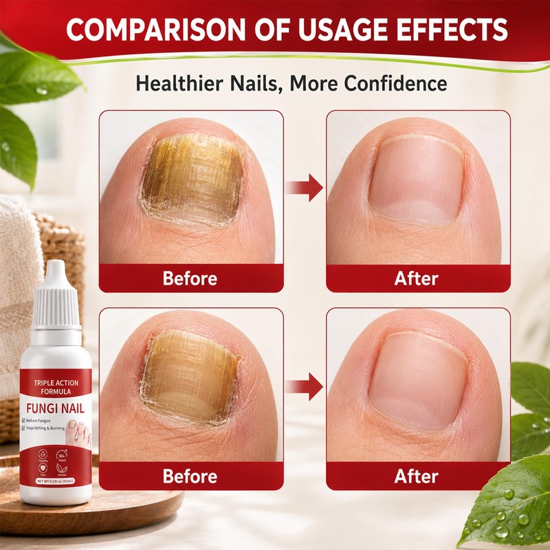 2PCS Fungi Nail ToenailTreatment,Gentle Formula,Effectively lmproves Nails for a More