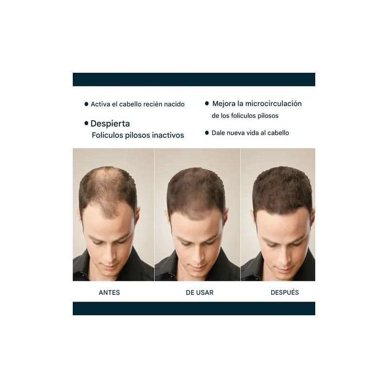 Pack de 3 Esencias Anticaída MOPOYAT para Hombre con Extra