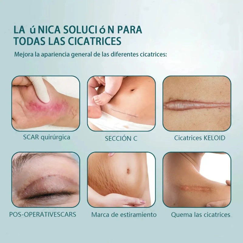 2 cajas Parche de silicona para cicatrices, adecuado para cicatrices