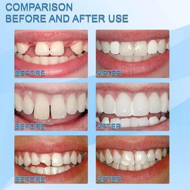 Temporary Tooth Filling Repair Kit with Denture Repair Beads,Filling Kit for Teeth,Moldable False Teeth,Missing Tooth Replacement K-It,Easily Shaped,Quick Fix for Missing,Broken,Or Chipped Te-ETH