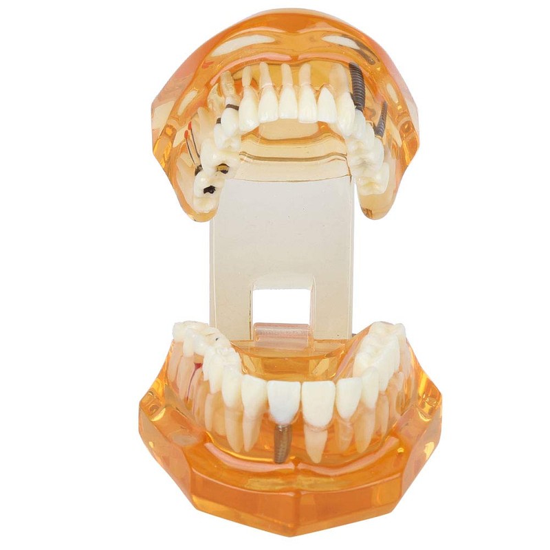 Dental Model Dental Disease Teaching Model Removable Implant Teeth Model