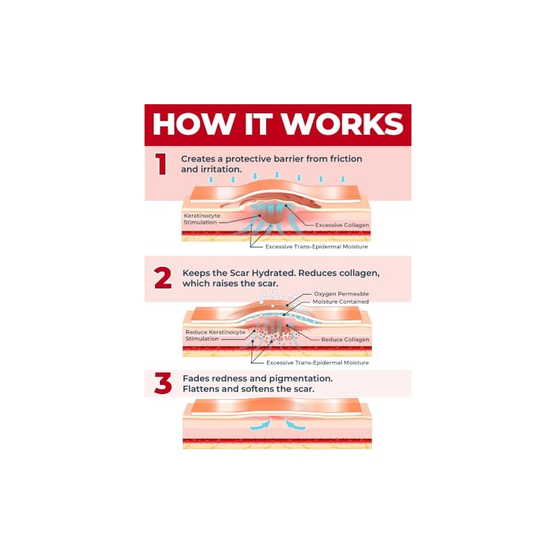 MYHELP Láminas De Silicona De Grado Médico Para Cicatrices -