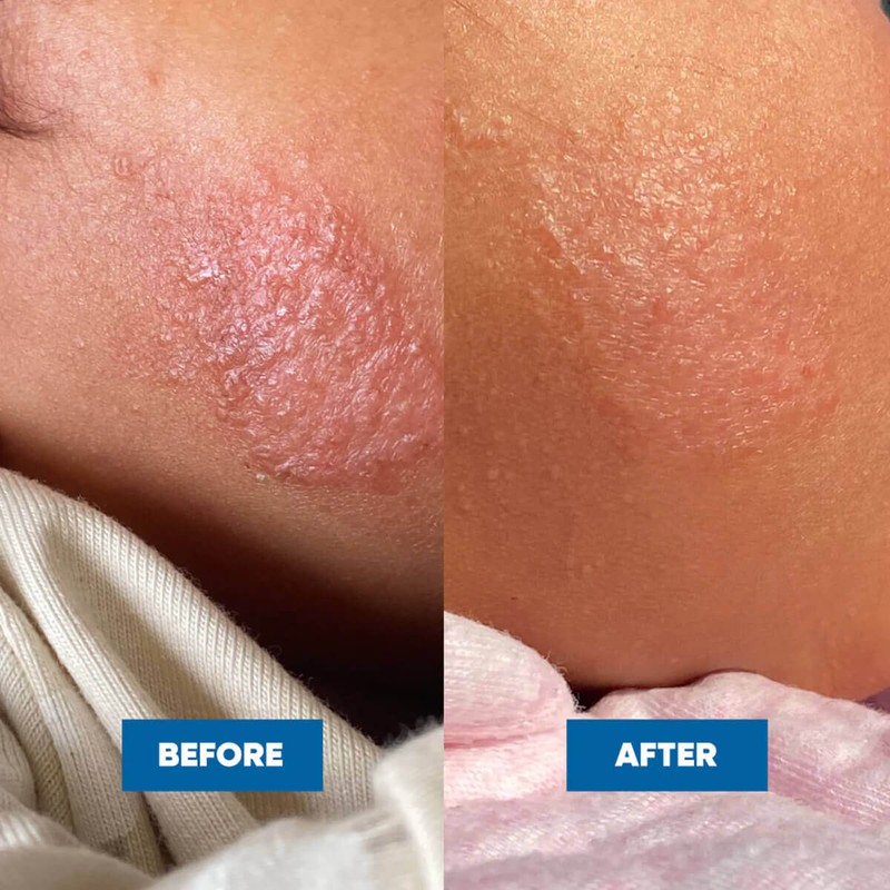 MooGoo Eczema & Psoriasis Cream, 120g