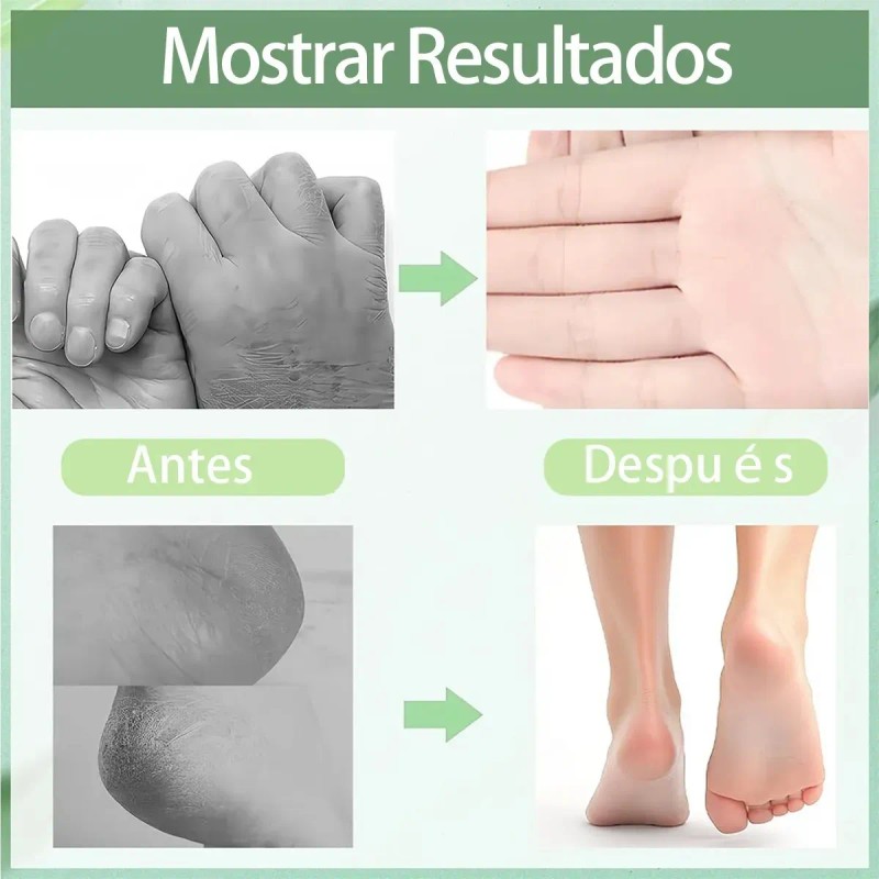 Crema Para Pies Con 60% Urea Y 2% Ácido Salicílico