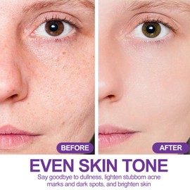 2Pcs 12% Acid Serum Cream - Dark Spot Remover for Face & Acne Treatment, Acne Cream Skin Care with Niacinamide & Hyaluronic Acid, Reduces Redness & Balances Skin Tone, Suitable for All Skin Types, 20g