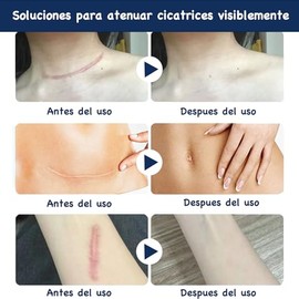 Parches de Silicona para Cicatrices - Reduce Quemaduras, Queloides, Estras y Acn, Cinta Reutilizable Postquirrgica,1.5M Largo, Antiguas y Nuevas (1)  