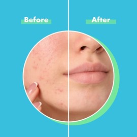 MedVance Advanced Hydrocolloid Acne Patches, Blemish Patches, Hydrocolloid..