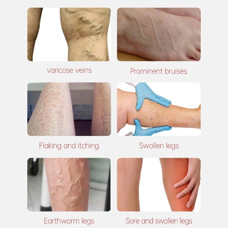 Varicose Veins Relief