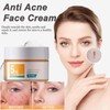 Anti Acne Cream,Daily Face Moisturiser for Acne Prone Skin &