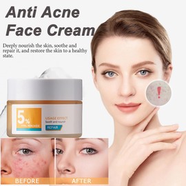 Anti Acne Cream,Daily Face Moisturiser for Acne Prone Skin & Blemish Control, Anti-Acne Removal Cream for Teenage Girl Women Men Skin Care - For Face, Back&Butt