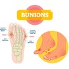 Pedag Hallux & Forefoot pad