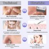 Peeling Ultrasónico Facial LOTOVERDE con 4 Modos y Limpieza Profunda