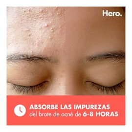 Parches para acné Hero Migthy Patch original 24 piezas