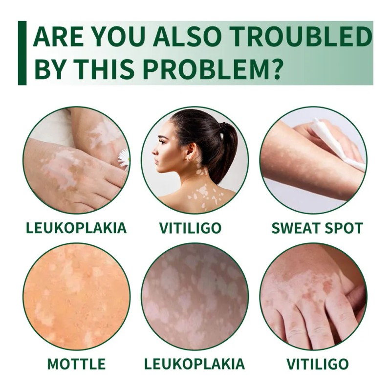 Vitíligo Aceite White Vitíligo Para 4×crema T