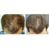 Best Acondicionador de Pérdida de Cabello Terapia de Crecimiento Rápido