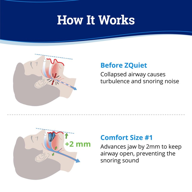 ZQuiet Anti-Snoring Mouthpiece Solution - Comfort Size #1 (Single Device)