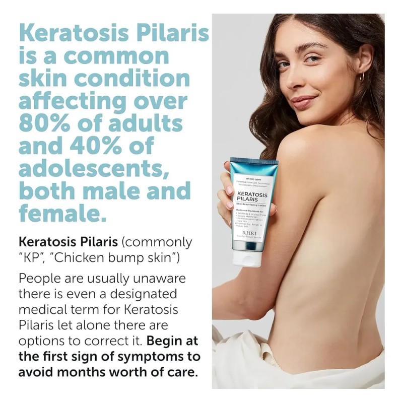Tratamiento Para La Queratosis Pilaris | Loción Para La Quer