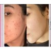 Crema Aclaradora Y Loción Quita Paño Manchas Acné Sol