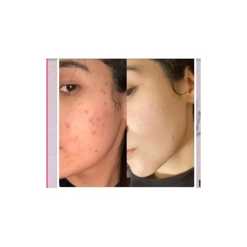 Crema Aclaradora Y Loción Quita Paño Manchas Acné Sol