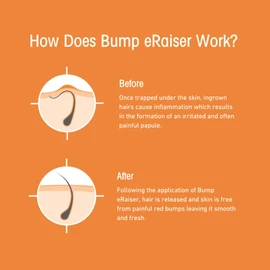 Bump Eraiser 5 Pack - The Complete Ingrown hair Solution in 1 Convenient Pack