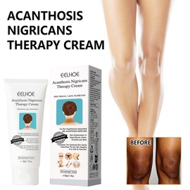 EELHOE Acanthosis Nigricans Therapy Cream, Nigrifree Acanthosis Nigricans Cream,Repair Cream Hydrating Moisturizers Cream Collagen Body Care Comfort