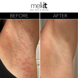 Body Melk Natural Body Cream - All Over Fast-Absorbing Hydration for Dry or Sensitive Skin - Soothe Sensitive Skin, Rash & Irritation - All Skin Types - 16 oz