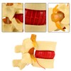 1:1.5 Anatomical Medical Human Spine Lumbar Disc Herniation Demonstration Model
