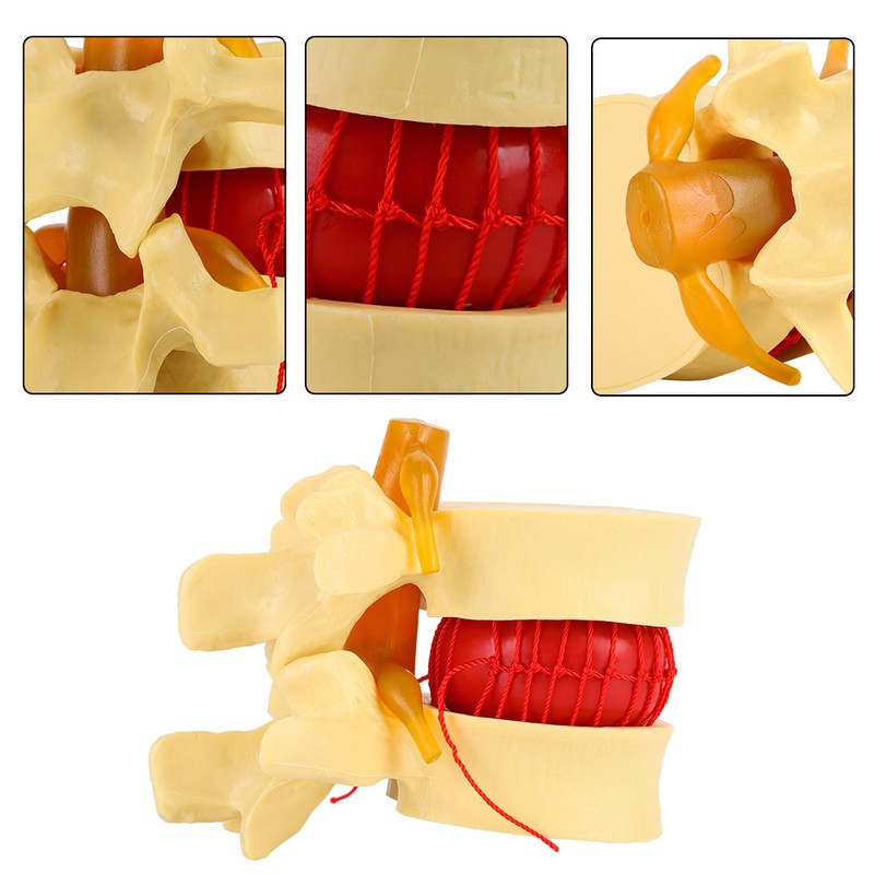 1:1.5 Anatomical Medical Human Spine Lumbar Disc Herniation Demonstration Model