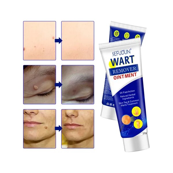 Crema Para Eliminar Verrugas En El Cuerpo Y La Cara