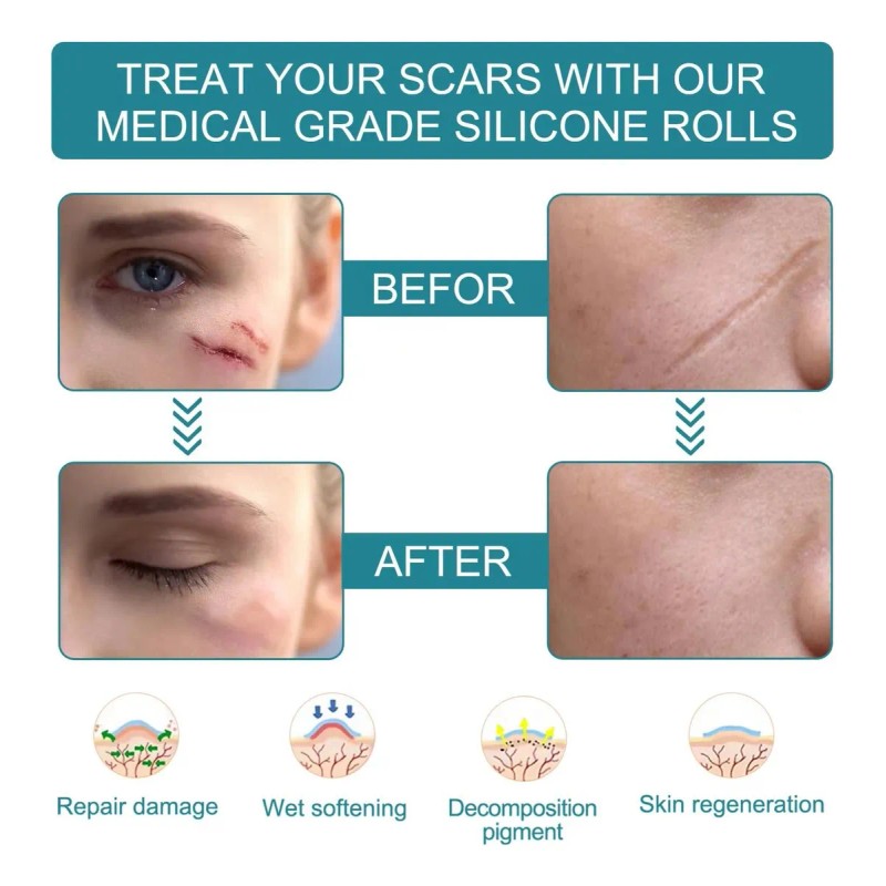 Rollo Cinta Silicona Para Reduccion Cicatrices Marcas Piel