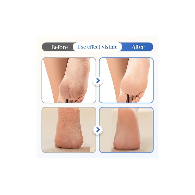 Crema Hidratante Y Antigrietas Para Pies Con 60 De Urea,