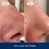 Hero Cosmetics Pore Release Blackhead Clearing Solution - Exfoliating Toner