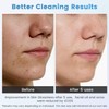 Lrbsule Pore Cleaner – Blackhead & Pimple Remover with 6