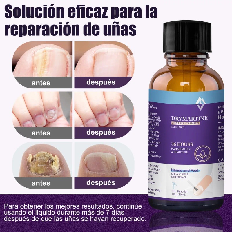 Fungicida Para Uñas Para Uñas Dañadas,rotas Y Decoloradas