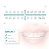 10 Paquetes de Soportes Dentales Cerámicos para Brackets Ortodónticos de