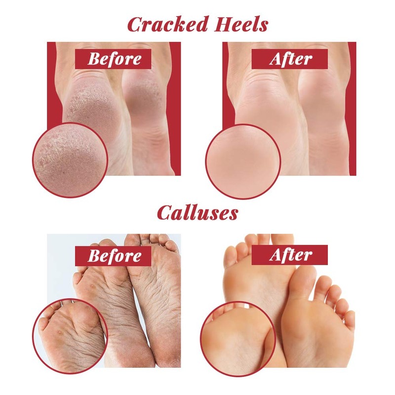 Checi Autoclave Sanitize and Sterilize Dual Coarse and Medium Foot