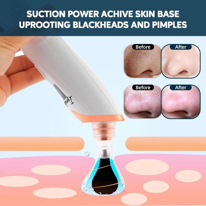 Limpiador De Poros Extractor De Puntos Negros Y Acné Facial