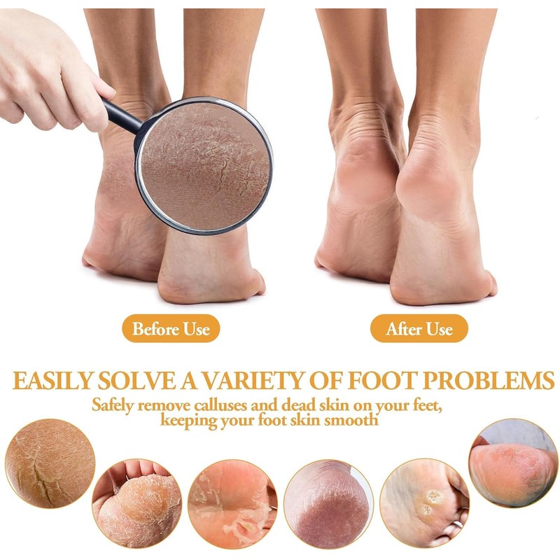 Foot File, Callus File, Pumice Stone Exfoliating Pedicure, Rasp Foot