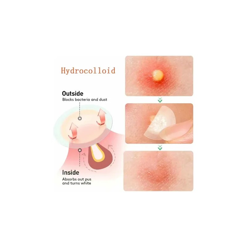 Parches Antiacné Absorbentes y Calmantes, Aplanan Imperfecciones