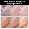 Dark Spot Remover for Face，-Age Spot Remover -Hyperpigmentation Treatment-Sun Spots