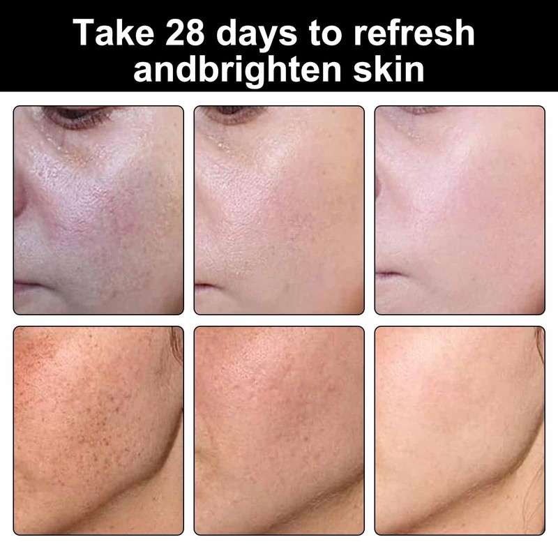 Dark Spot Remover for Face，-Age Spot Remover -Hyperpigmentation Treatment-Sun Spots