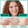 Crema Tratamiento Para Manchas Acné Con Ácido Hialuronico