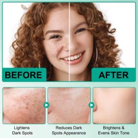 Crema Tratamiento Para Manchas Acné Con Ácido Hialuronico