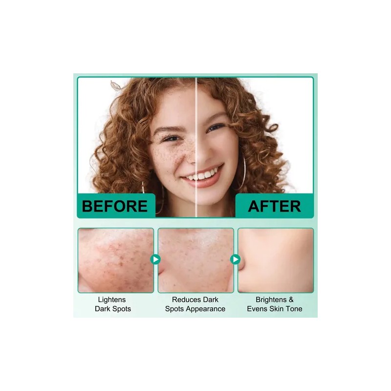 Crema Tratamiento Para Manchas Acné Con Ácido Hialuronico