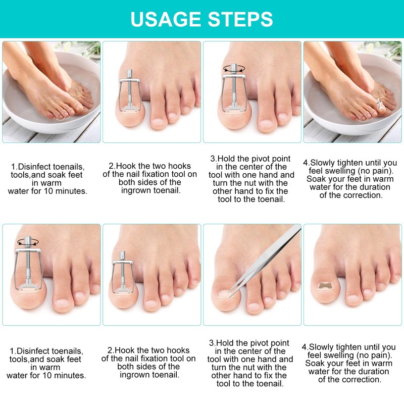 Ingrown Toenails Set Toenail Correction Patch Corrector Pedicure Stainless Steel