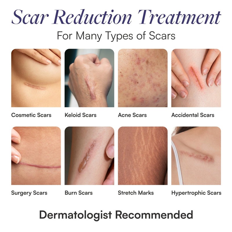 Scar Smart Scar Sheets - Scar Cream Strips for Surgical