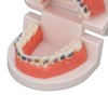 Dental Typodont Teeth Model with Orthodontic Metal Bracket for Dentist