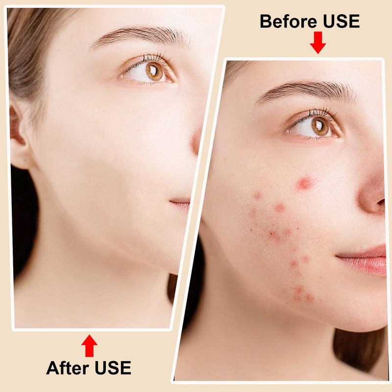 jaxiria 2 Pack 2-in-1 Pimple Extractor Removal Tools - Professional