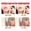 🔥 240pzs mascarillas parches para el acne espinillas granos Vitaminas